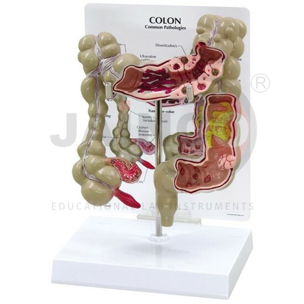 Colon Model With Pathologies