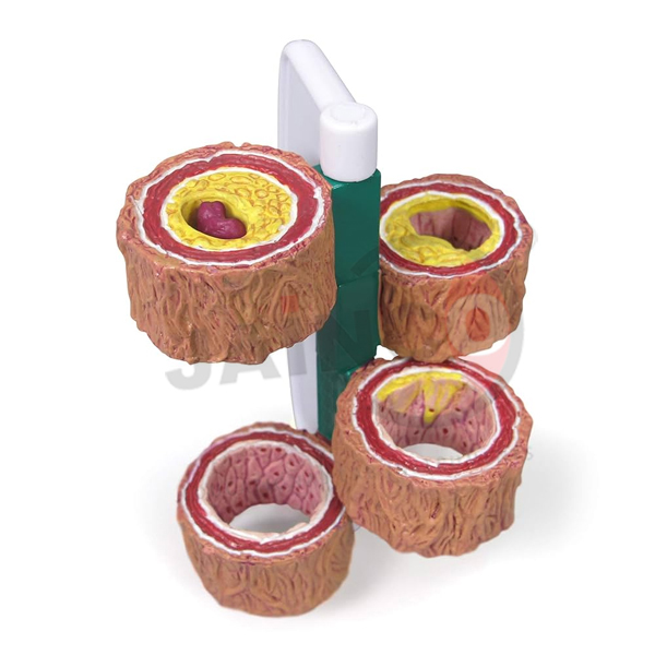 Artery Model Showing Plaque Building