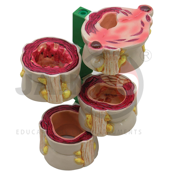 Colon Model Set of 4 Pcs