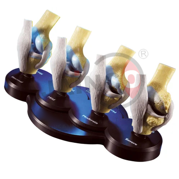 Four-Stage Osteoarthritis Knee Model
