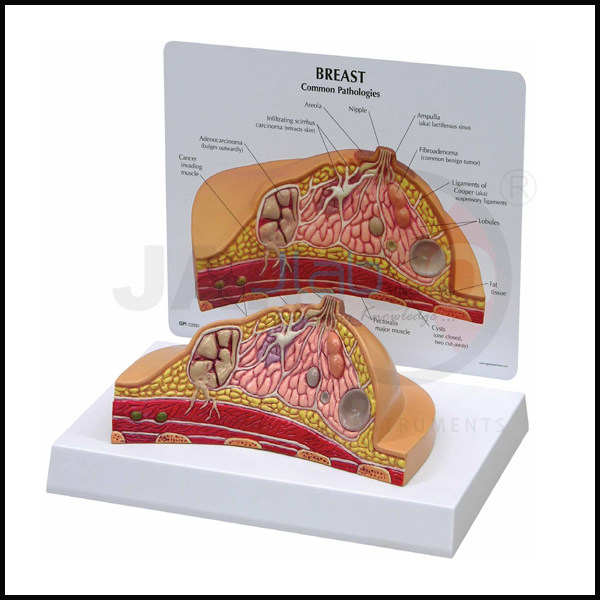 Breast Cancer Model