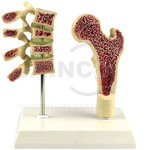 Menopausal Osteoporosis Model
